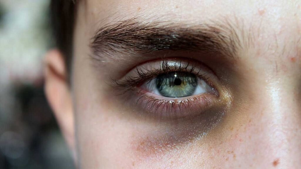 سبب سواد تحت العين