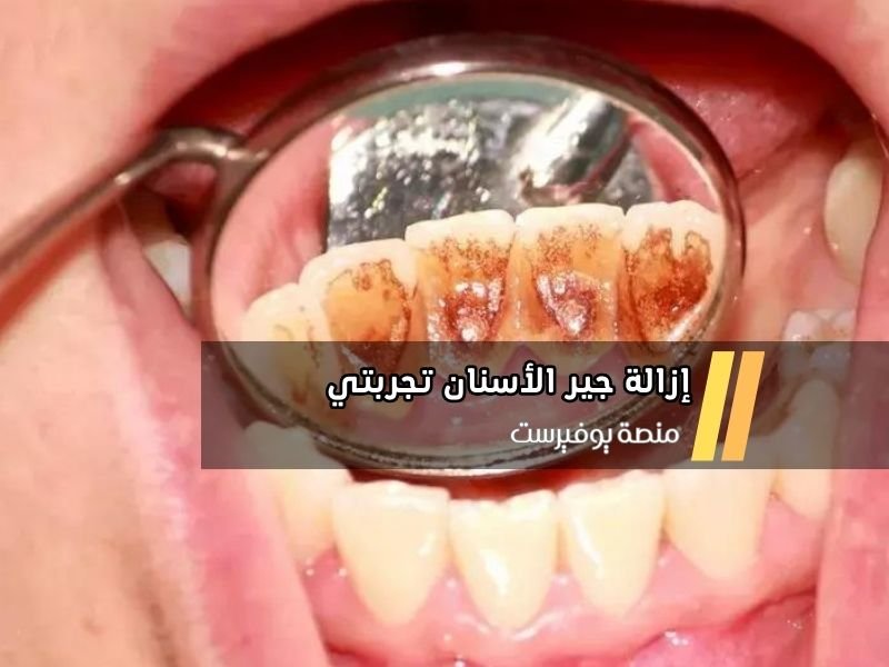 إزالة جير الأسنان تجربتي