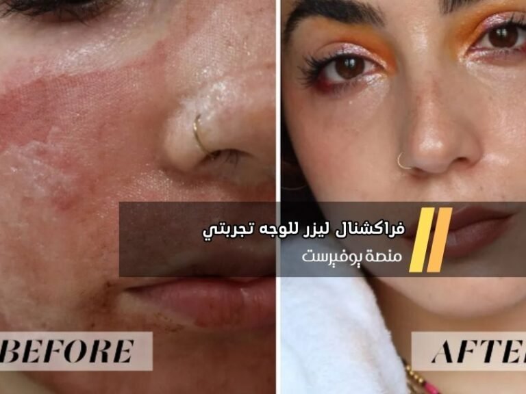 فراكشنال ليزر للوجه تجربتي