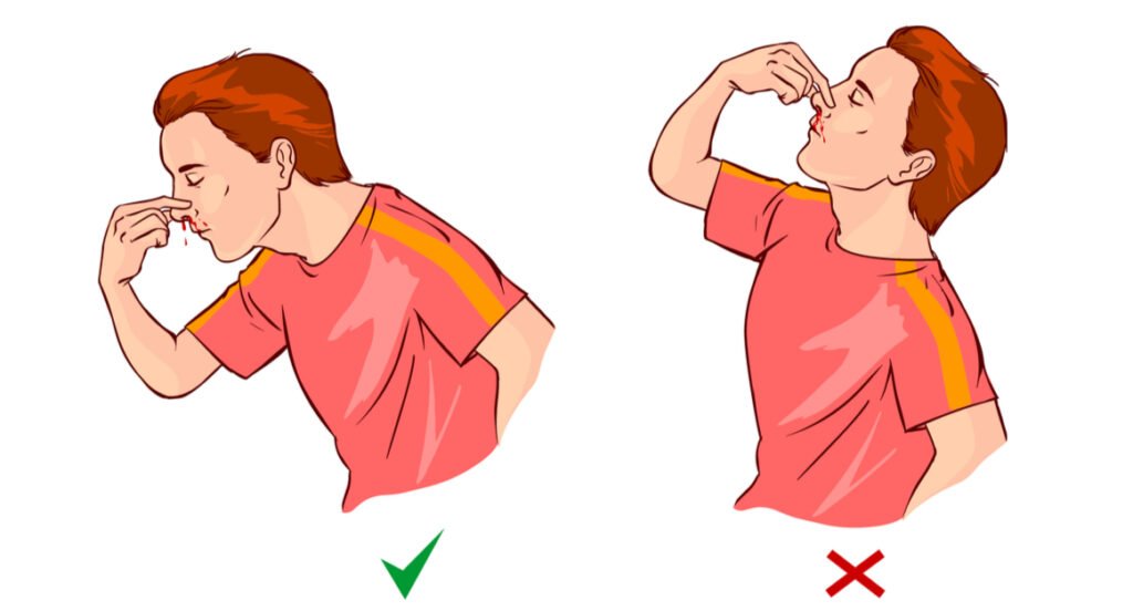 سبب نزول الدم من الأنف من فتحة واحدة